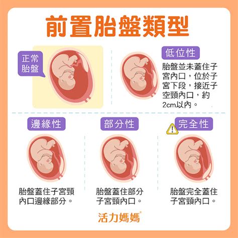 炭部首 前置胎盤症狀